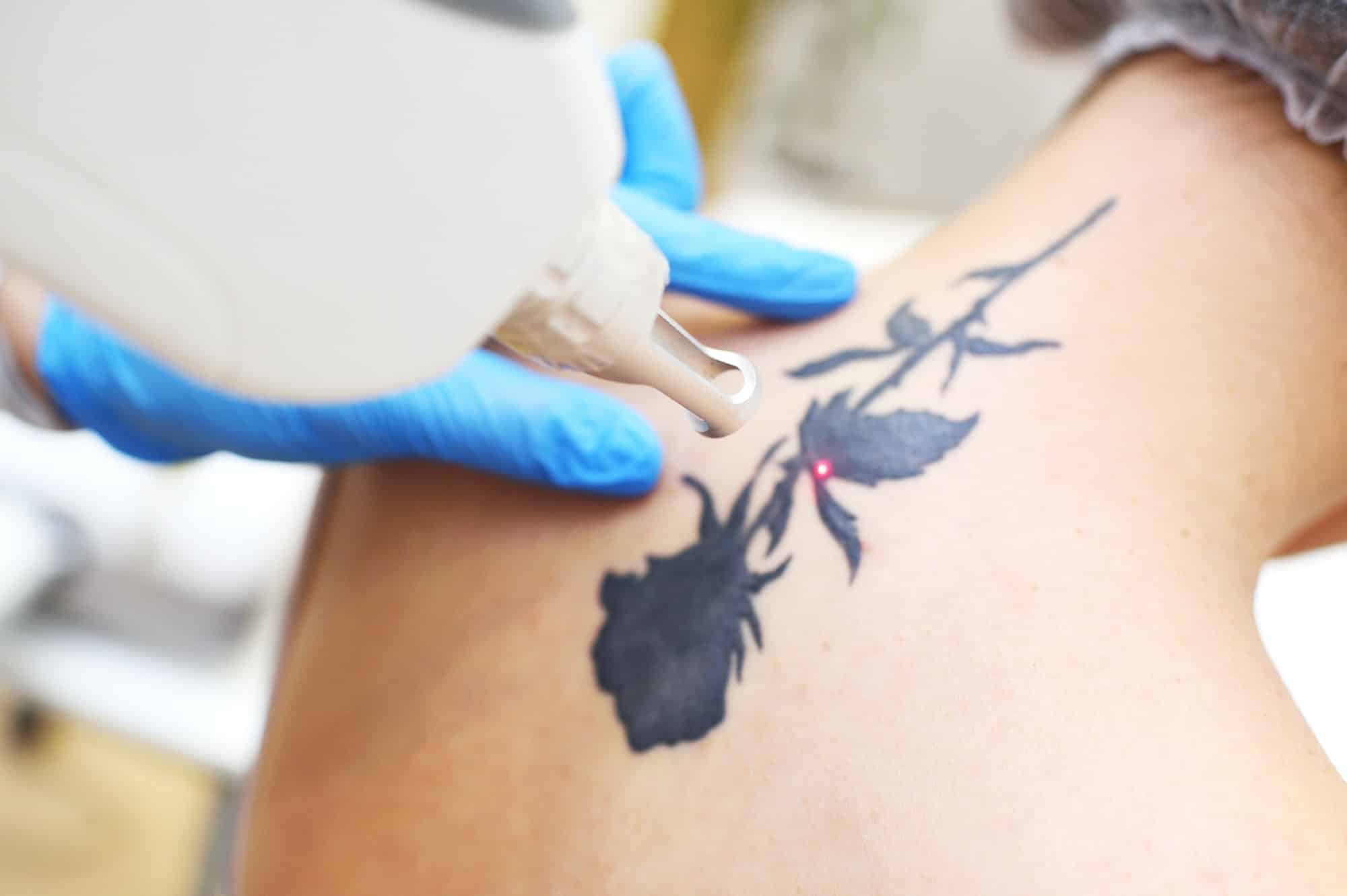Tatoeage verwijderen met Pico Laser